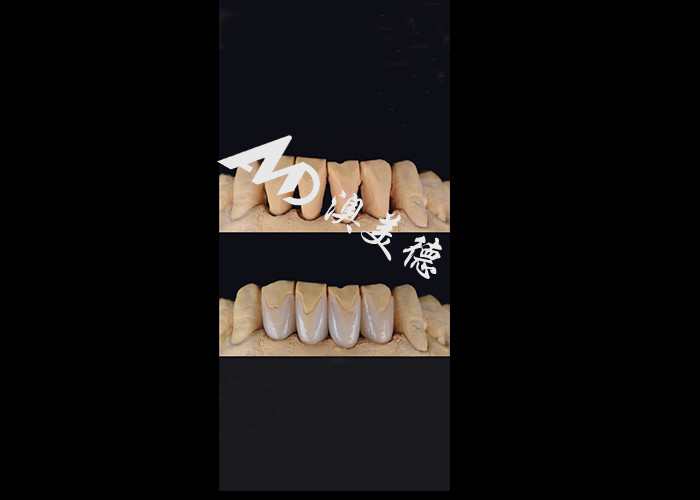 0.3-0.5mm Ultra sottile IPS EMAX Porcellane Veneers per il Makeover del sorriso estetico