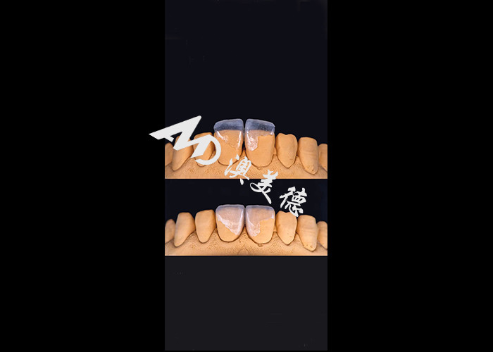 0.3-0.5mm Ultra sottile IPS EMAX Porcellane Veneers per il Makeover del sorriso estetico