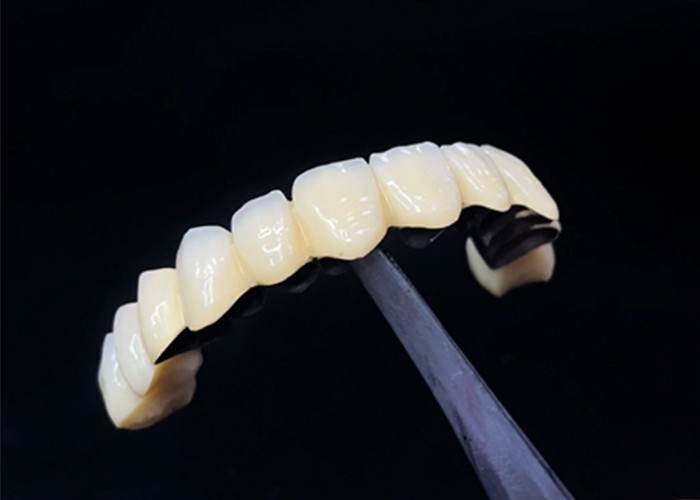 Porcellana fusa con corona metallica che combina durata e bellezza per la salute dentale