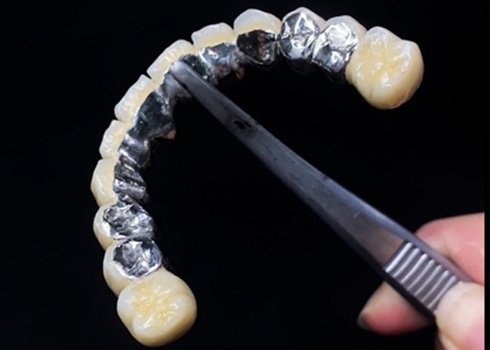 Porcellana fusa con corona metallica che combina durata e bellezza per la salute dentale