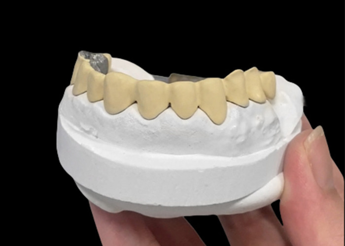 Porcellana fusa con corona metallica che combina durata e bellezza per la salute dentale