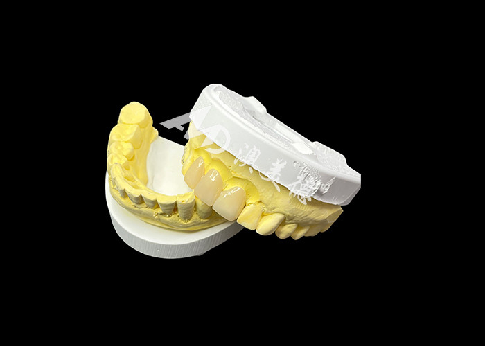 Migliora l'estetica dentale con un ponte corona in ceramica che combina estetica eccezionale e eccezionale biocompatibilità per un sorriso naturale e comodo
