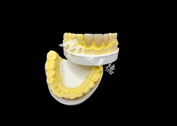 Migliora l'estetica dentale con un ponte corona in ceramica che combina estetica eccezionale e eccezionale biocompatibilità per un sorriso naturale e comodo