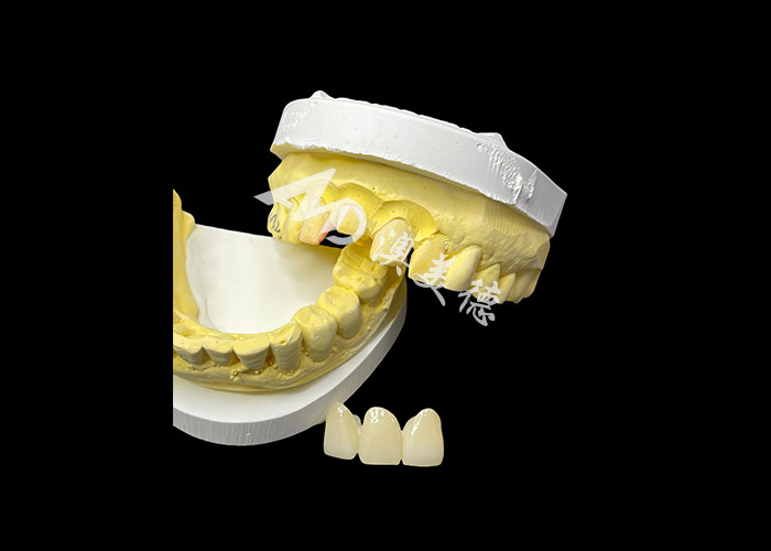 Migliora l'estetica dentale con un ponte corona in ceramica che combina estetica eccezionale e eccezionale biocompatibilità per un sorriso naturale e comodo