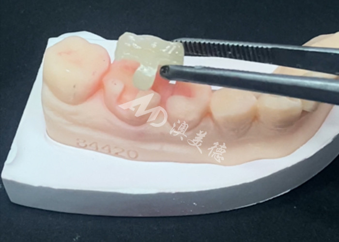 Emax Inlays in ceramica Onlays Restaurazioni dentali per colore naturale dei denti e facile manutenzione