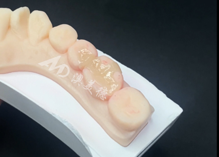 Emax Inlays in ceramica Onlays Restaurazioni dentali per colore naturale dei denti e facile manutenzione