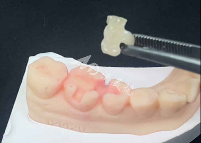 Emax Inlays in ceramica Onlays Restaurazioni dentali per colore naturale dei denti e facile manutenzione