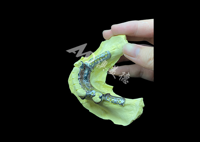 Denti parziali con estetica personalizzata e adattamento sicuro per un maggiore comfort e funzionalità