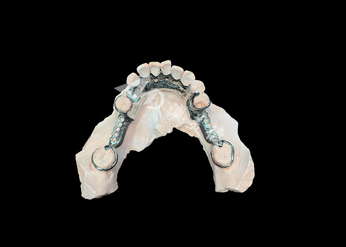 Denti parziali con estetica personalizzata e adattamento sicuro per un maggiore comfort e funzionalità