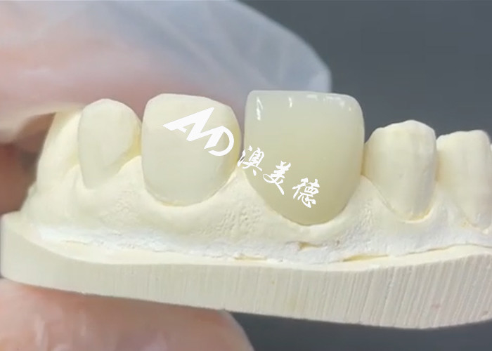 Veneer EMAX durevole ed estetico La soluzione perfetta per i restauri di porcellane