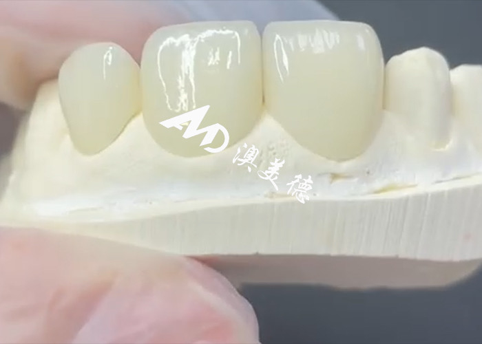 Veneer EMAX durevole ed estetico La soluzione perfetta per i restauri di porcellane