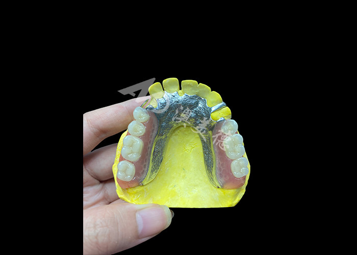 Protesi parziali a fusione regolabile per un maggiore comfort e stabilità, perfette per masticare e parlare