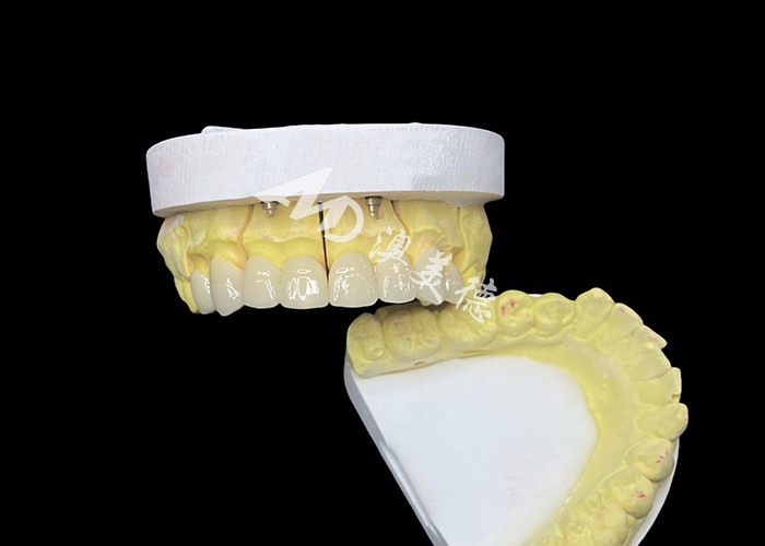Raggiungi un sorriso perfetto con corone dentali in ceramica di alta qualità per un aspetto naturale e una resistenza duratura