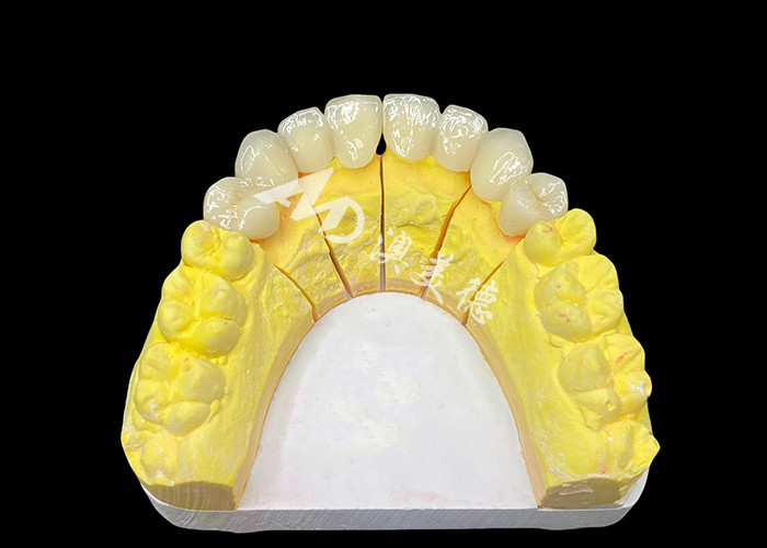 Raggiungi un sorriso perfetto con corone dentali in ceramica di alta qualità per un aspetto naturale e una resistenza duratura