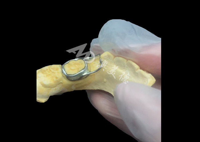 Ortodontic Space maintainer un inestimabile dispositivo che protegge ingegnosamente gli spazi dentali dei bambini assicurando il corretto sviluppo dei denti.
