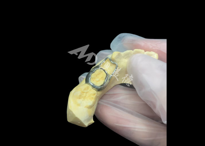 Ortodontic Space maintainer un inestimabile dispositivo che protegge ingegnosamente gli spazi dentali dei bambini assicurando il corretto sviluppo dei denti.