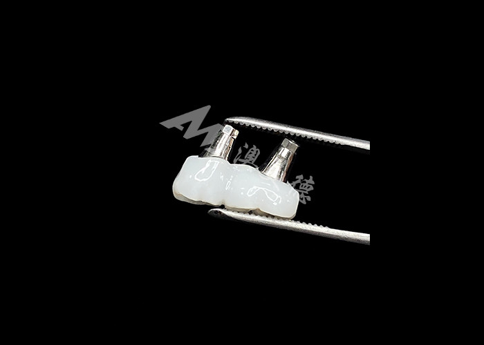 Corone per impianti dentali in zirconia con supporto in titanio per un maggiore comfort ed estetica