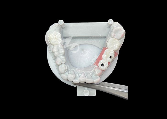 Corone per impianti dentali in zirconia con supporto in titanio per un maggiore comfort ed estetica