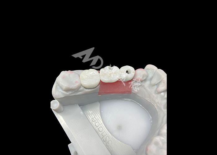 Corone per impianti dentali in zirconia con supporto in titanio per un maggiore comfort ed estetica