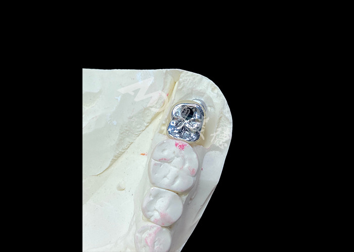 Corona di impianto dentale con supporto in titanio e corona PFM in porcellana fusa in metallo