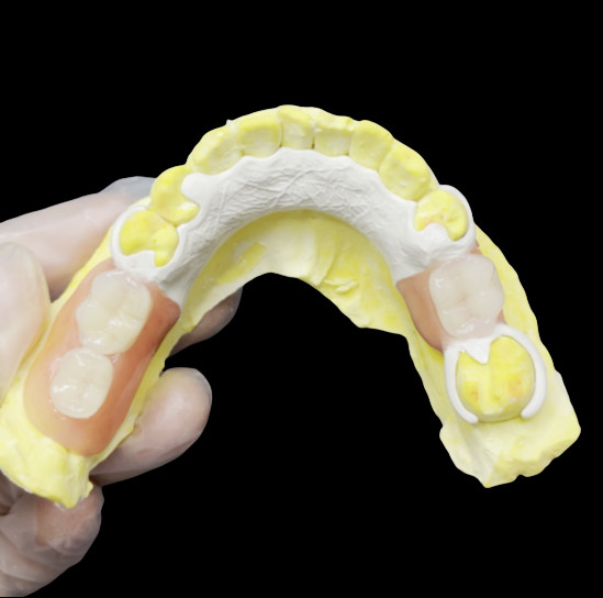 Estetica Denti parziali rimovibili realizzati su misura HPP Quadro per la sostituzione parziale naturale dei denti