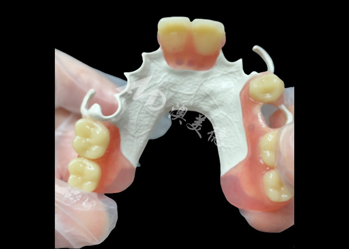 Estetica Denti parziali rimovibili realizzati su misura HPP Quadro per la sostituzione parziale naturale dei denti