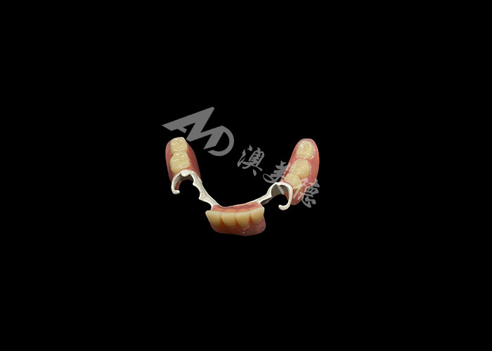 Dentiere parziali di casture durevoli su misura con telaio HPP per ripristinare il tuo sorriso