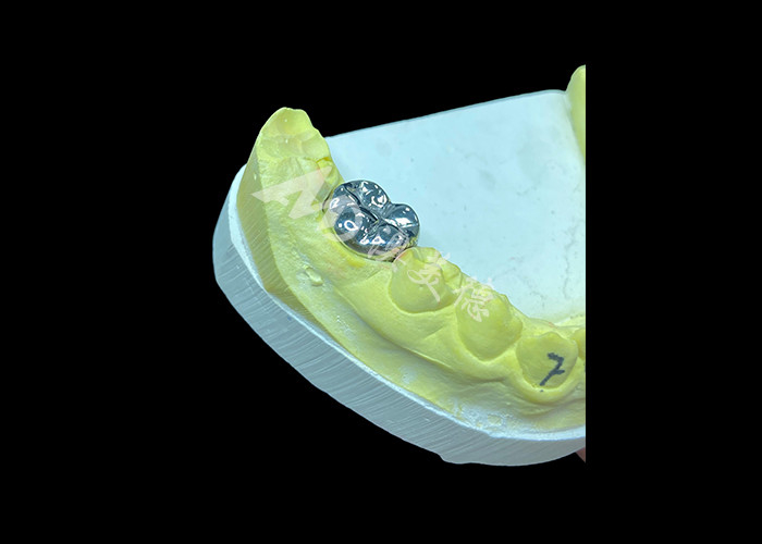 Funzione duratura Corona fusa in metallo durabile per la restaurazione dei denti superiore