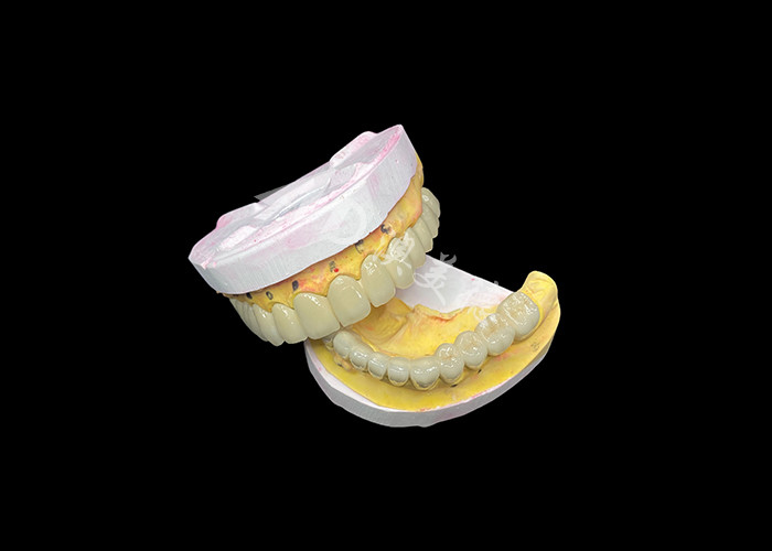 Porcellana personalizzata fusa a metallo per il miglioramento del sorriso naturale