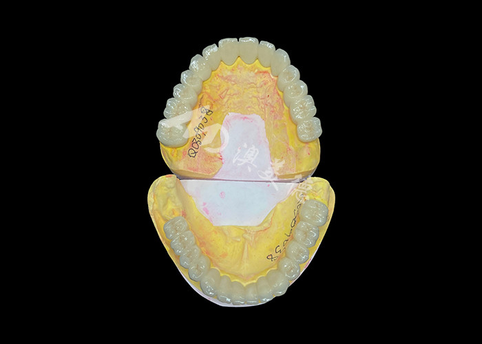 Porcellana personalizzata fusa a metallo per il miglioramento del sorriso naturale