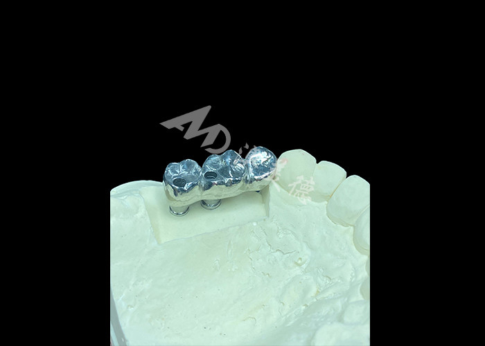 Impianto dentale a corona in titanio a lunga durata per sostituzione di denti mancanti