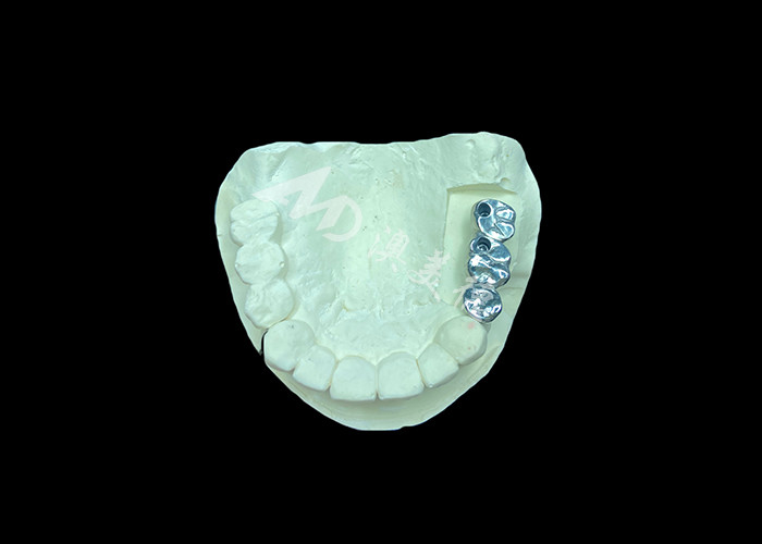 Impianto dentale a corona in titanio a lunga durata per sostituzione di denti mancanti
