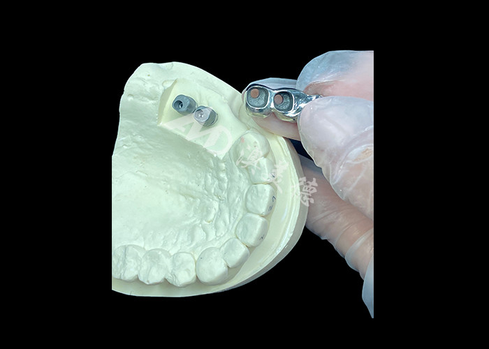 Impianto dentale a corona in titanio a lunga durata per sostituzione di denti mancanti