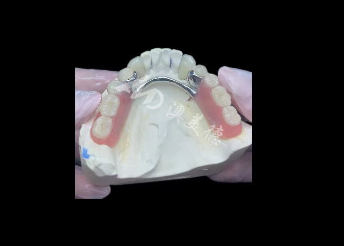 Porcellana resistente fusa al metallo corona dentale PFM corona per il restauro