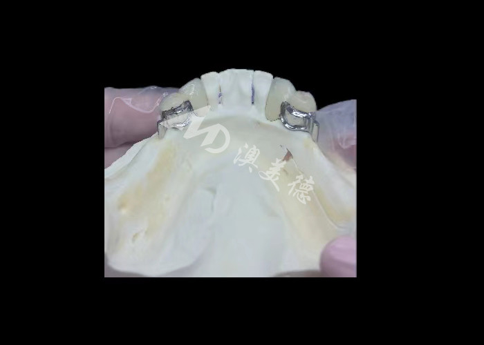 Porcellana resistente fusa al metallo corona dentale PFM corona per il restauro