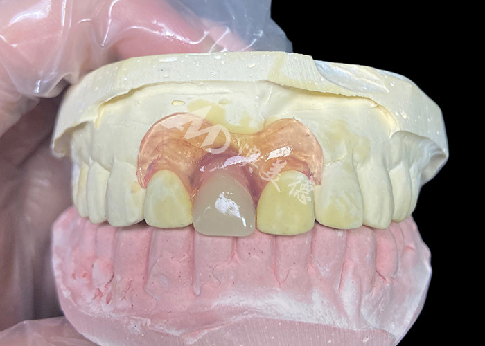 Protesi parziali flessibili Nesbit per incisivi che offrono una soluzione di sostituzione dei denti rimovibile senza saldature