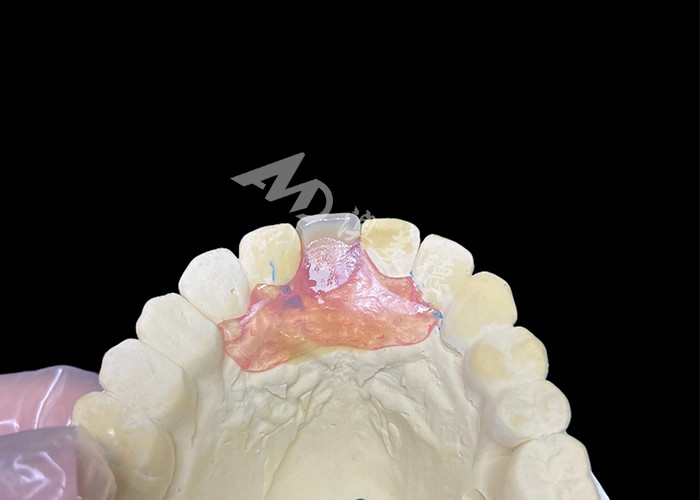 Protesi parziali flessibili Nesbit per incisivi che offrono una soluzione di sostituzione dei denti rimovibile senza saldature