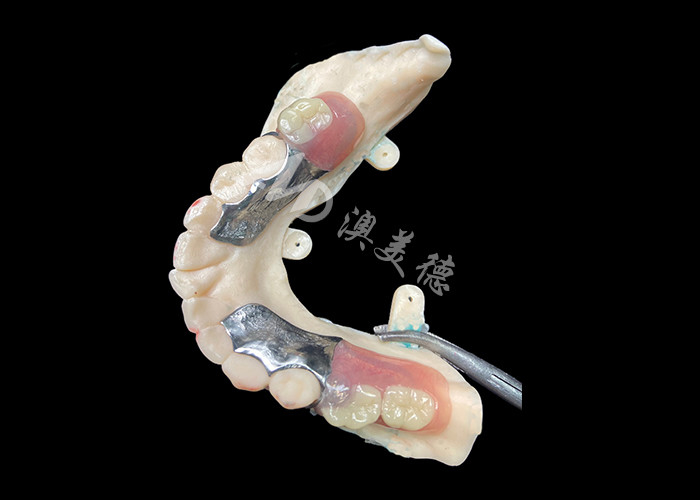 Denti parziali di precisione per l'adeguamento e la funzionalità ottimali