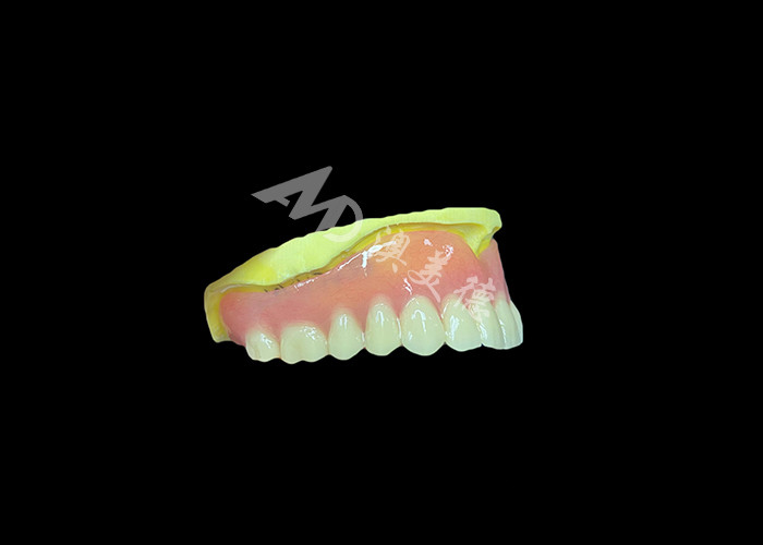 Denti parziali fuse progettate per la durata, il comfort e l'estetica e una durata maggiore