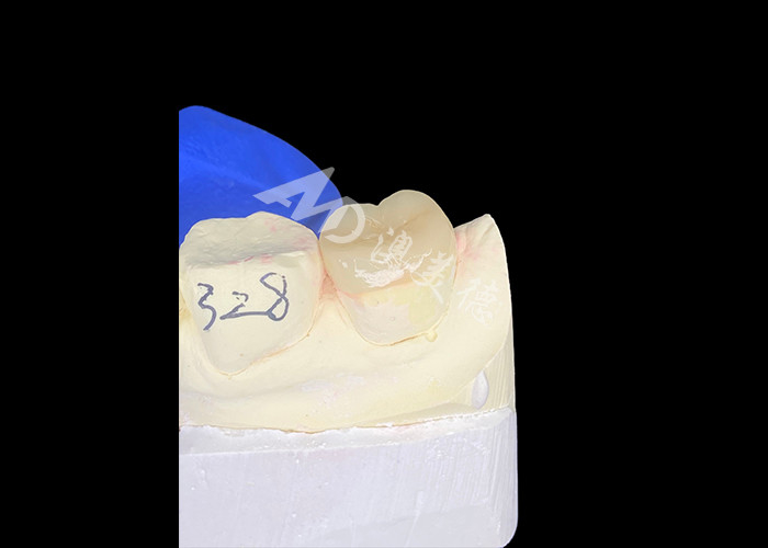 IPS E.max Infissi in ceramica Infissi in onlays Miscela senza saldature A aspetto naturale E resistente ai denti