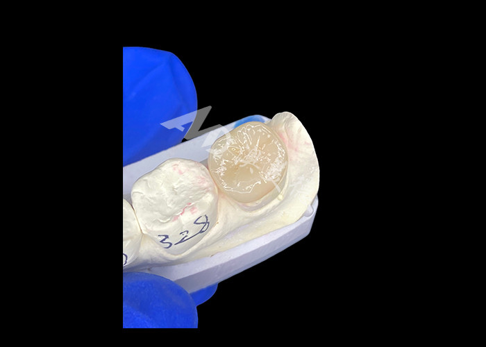 IPS E.max Infissi in ceramica Infissi in onlays Miscela senza saldature A aspetto naturale E resistente ai denti