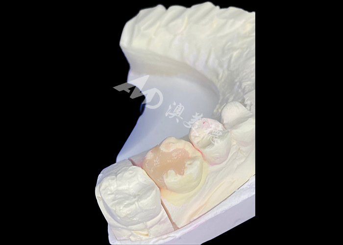 IPS e.max Infissi e infissi in ceramica per il restauro molare con risultati estetici e naturali duraturi