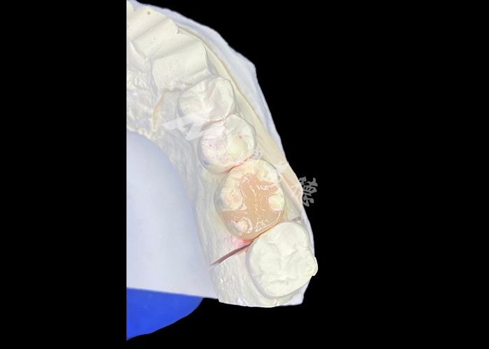 IPS e.max Infissi e infissi in ceramica per il restauro molare con risultati estetici e naturali duraturi