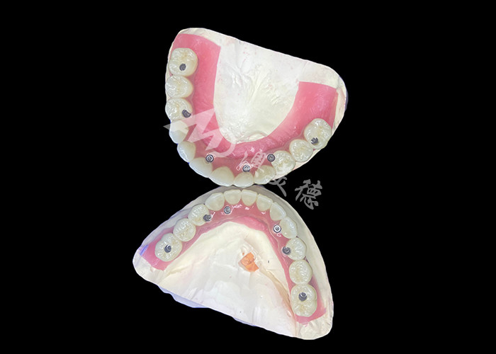 Dental All-on-6 Dental Implant Supported Dentures con stabilità e comfort