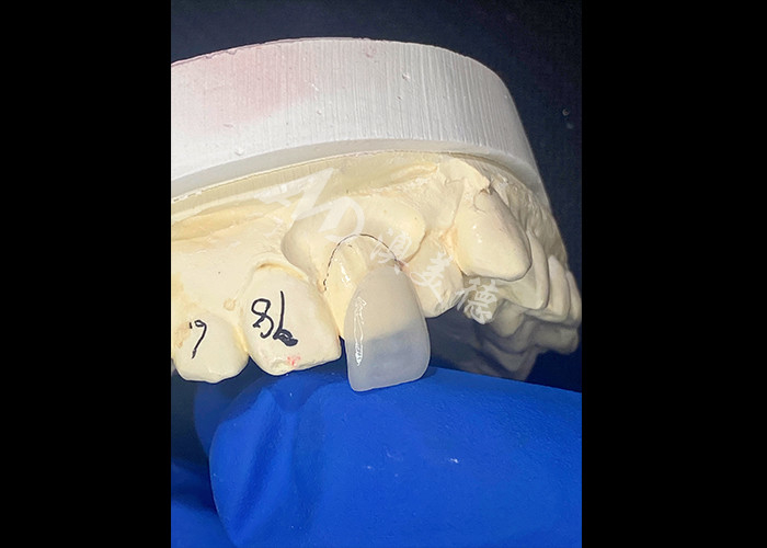IPS e.max Finiture per incisivi in tonalità A1 Estetica naturale per sorrisi impeccabili