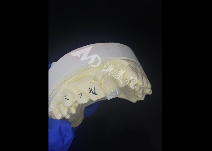 IPS e.max Finiture per incisivi in tonalità A1 Estetica naturale per sorrisi impeccabili
