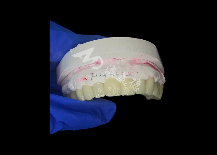 Ponte dentale in zirconia ad alta traslucidità Forte e naturale per il ripristino del sorriso senza soluzione di continuità