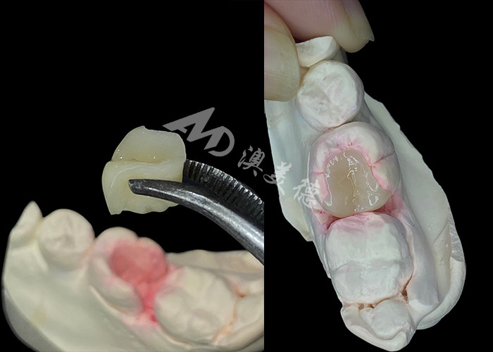 IPS e.max Infissi e infissi in ceramica per il restauro dentale dall'aspetto naturale