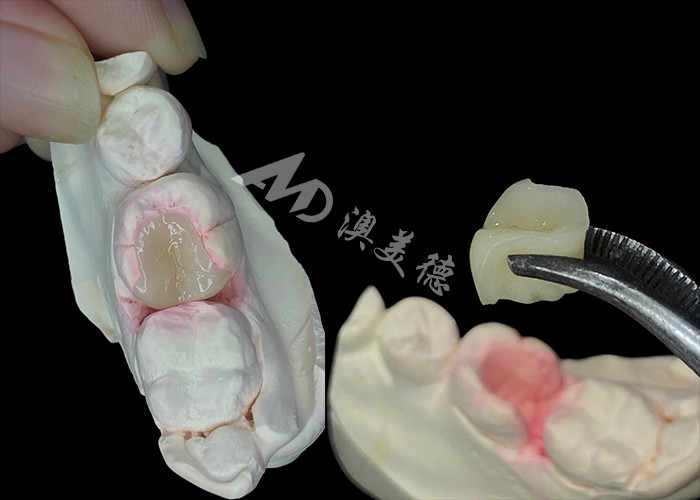 IPS e.max Infissi e infissi in ceramica per il restauro dentale dall'aspetto naturale