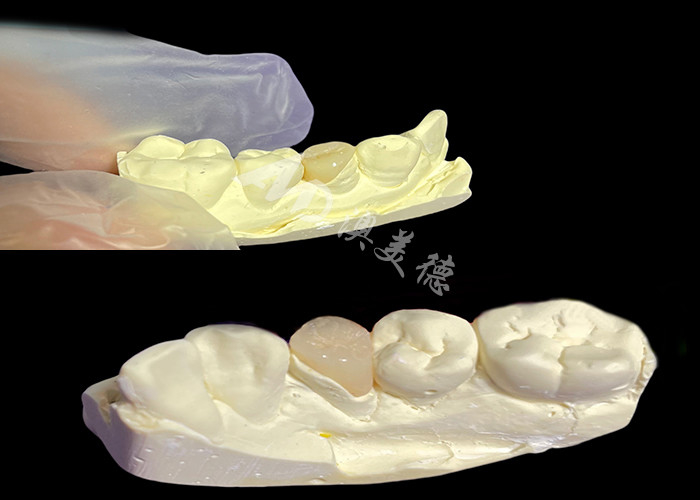 IPS e.max Infissi e infissi in ceramica per il restauro dentale dall'aspetto naturale